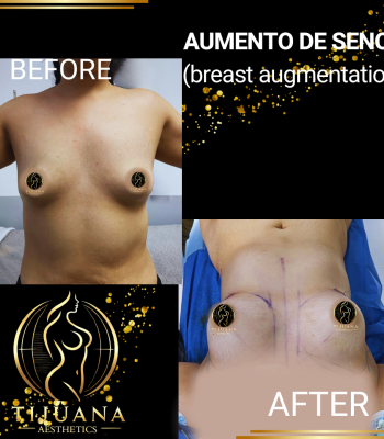 BREAST AUGMENTATION (4)