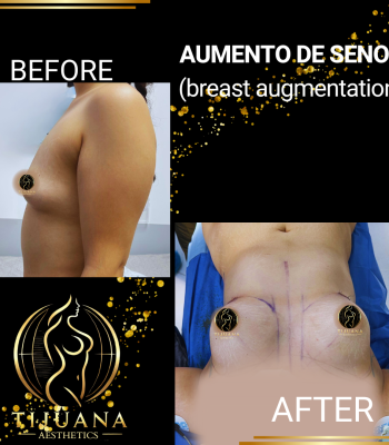 BREAST AUGMENTATION (5)