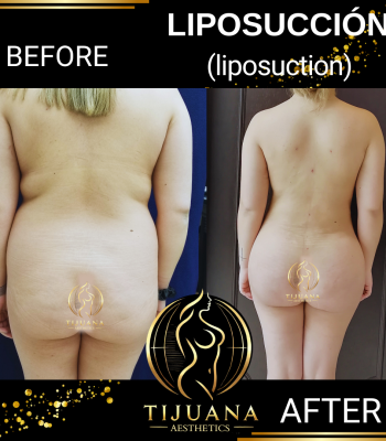 LIPOSUCTION