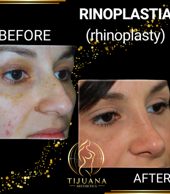 RINOPLASTIA (2)