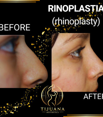 RINOPLASTIA (3)