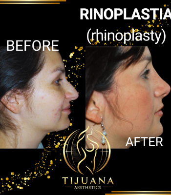 RINOPLASTIA (4)