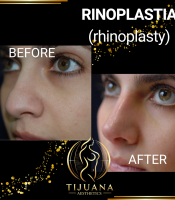 RINOPLASTIA (7)