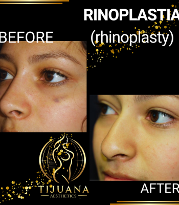 RINOPLASTIA