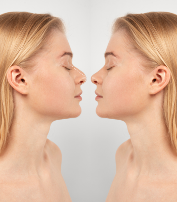 Rhinoplasty (2)