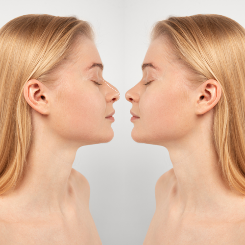 Rhinoplasty (2)