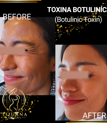 TOXINA BOTULINíCA (6)