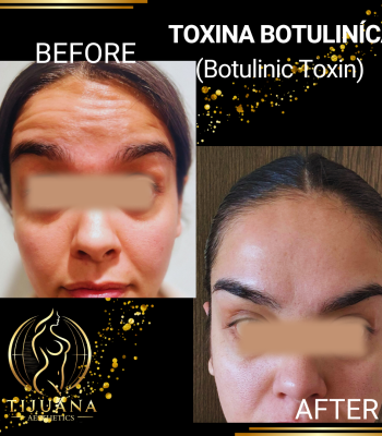 TOXINA BOTULINíCA (7)