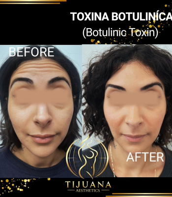 TOXINA BOTULINíCA (8)