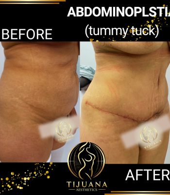 TUMMY TUCK